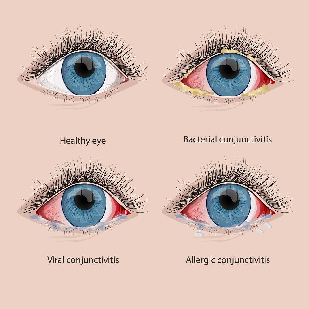 Viral Conjunctivitis: Symptoms, Causes, and Treatment